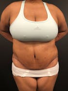 Plus Size Tummy Tuck® Gallery - Patient 14089785 - Image 2