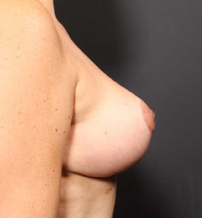 Breast Lift Mastopexy Before & After Gallery - Patient 14089782 - Image 10