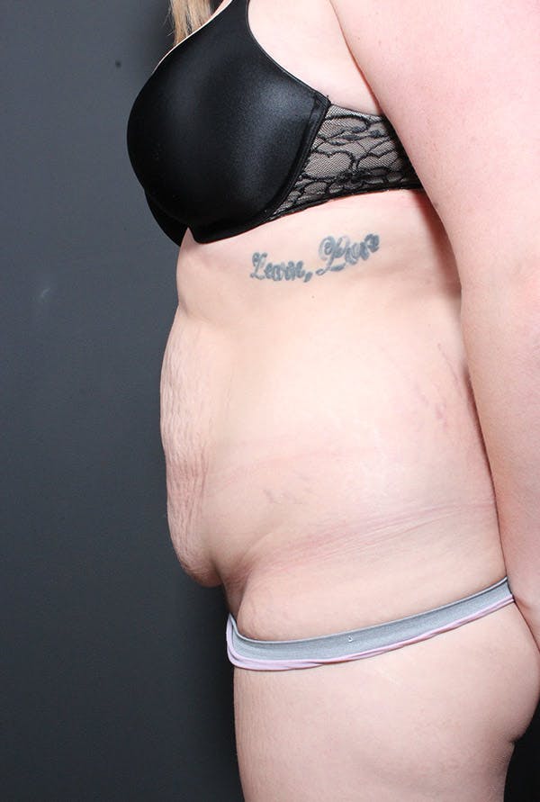 Liposuction Before & After Gallery - Patient 14089783 - Image 5