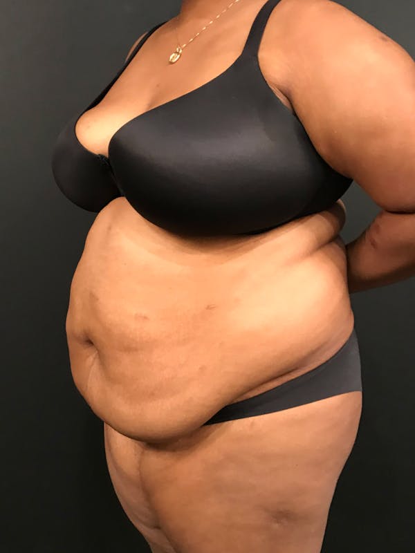Plus Size Tummy Tuck® Before & After Gallery - Patient 14089785 - Image 3