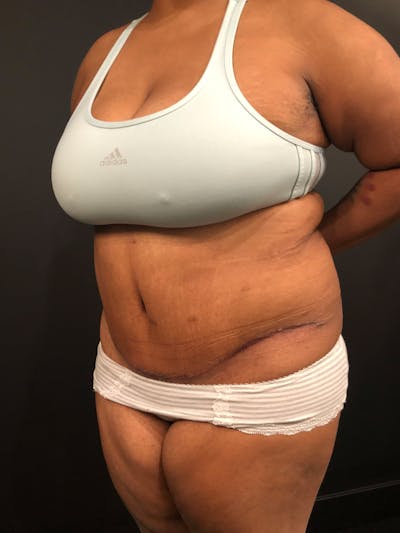 Plus Size Tummy Tuck® Before & After Gallery - Patient 14089785 - Image 4