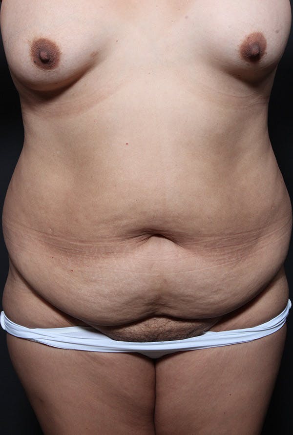 Liposuction Before & After Gallery - Patient 14089789 - Image 3