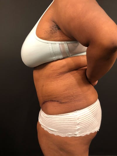 Plus Size Tummy Tuck® Gallery - Patient 14089785 - Image 6