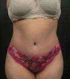 Plus Size Tummy Tuck® Before & After Gallery - Patient 14089788 - Image 2