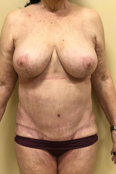 Breast Lift Mastopexy Before & After Gallery - Patient 14089790 - Image 2