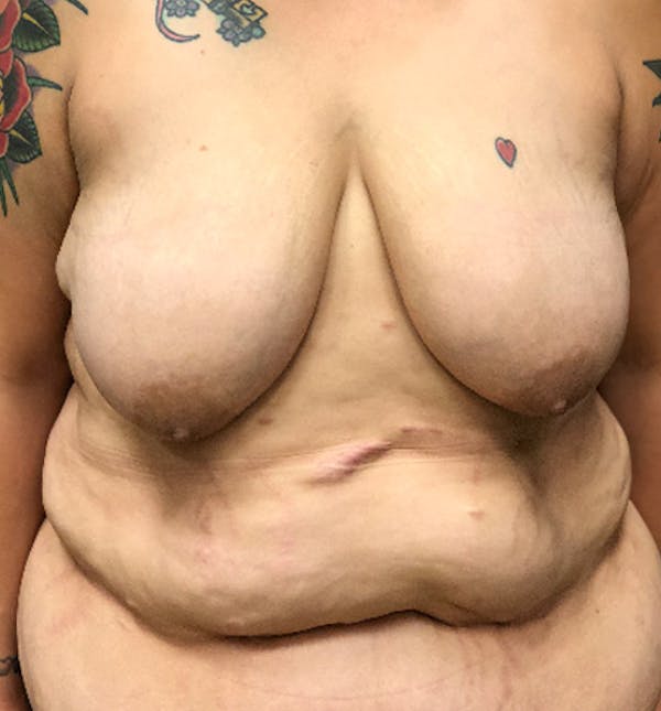 Breast Lift Mastopexy Before & After Gallery - Patient 14089791 - Image 1