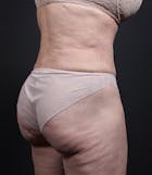 Liposuction Before & After Gallery - Patient 14089798 - Image 2