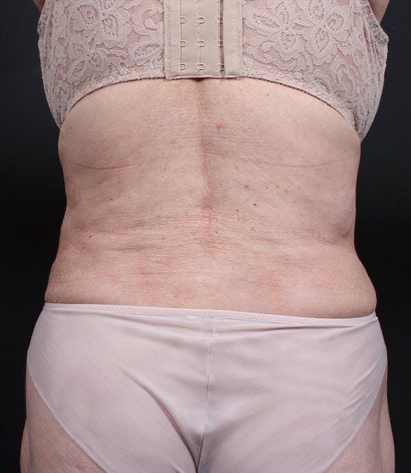 Liposuction Before & After Gallery - Patient 14089798 - Image 4