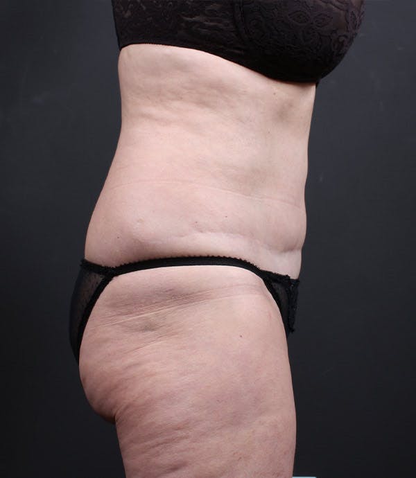 Liposuction Before & After Gallery - Patient 14089798 - Image 5