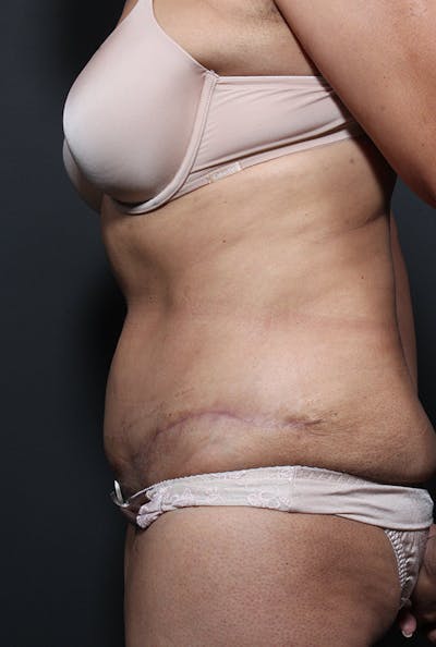 Mommy Makeover Before & After Gallery - Patient 14089797 - Image 6