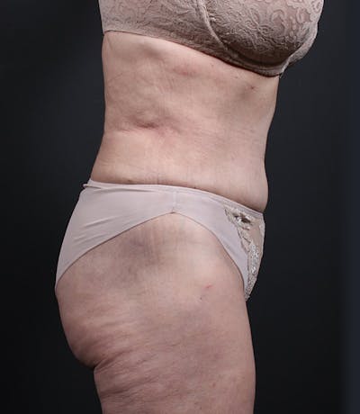 Liposuction Gallery - Patient 14089798 - Image 6