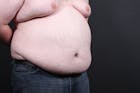 Liposuction Gallery - Patient 14089801 - Image 1