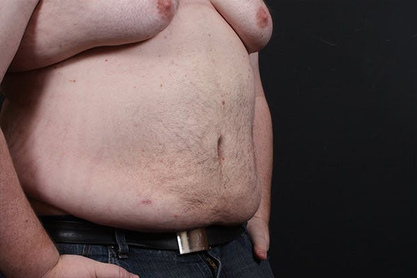Liposuction Before & After Gallery - Patient 14089801 - Image 2