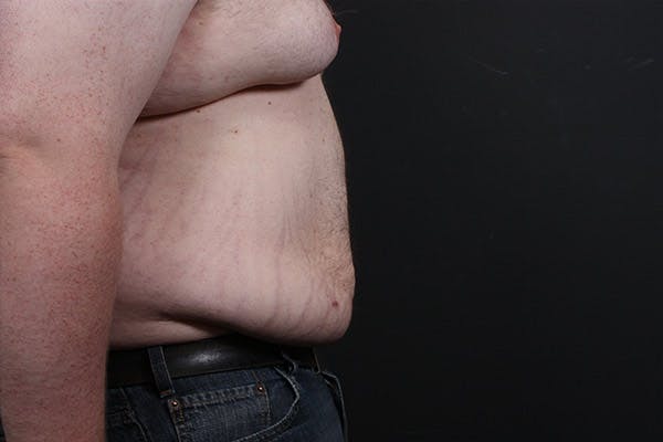 Liposuction Before & After Gallery - Patient 14089801 - Image 6