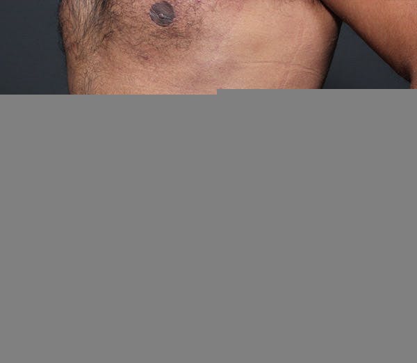 Liposuction Gallery - Patient 14089803 - Image 2