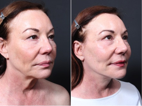 Natural face lift by Dr Repta