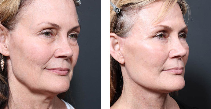 Dr. Repta facelift before & after