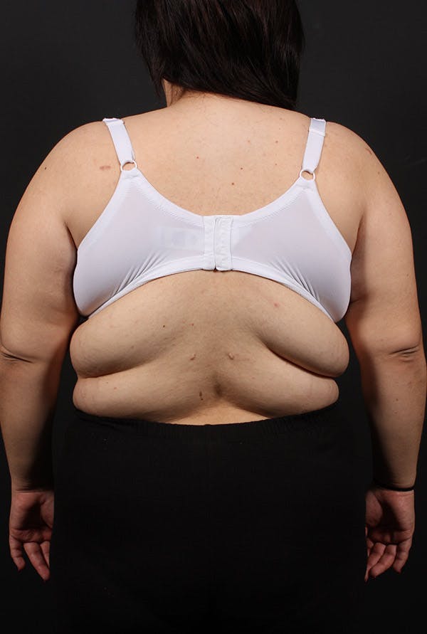 Liposuction Before & After Gallery - Patient 14089817 - Image 3