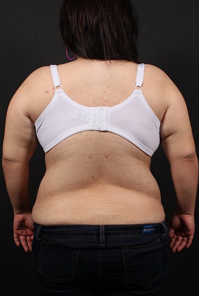 Liposuction Before & After Gallery - Patient 14089817 - Image 4