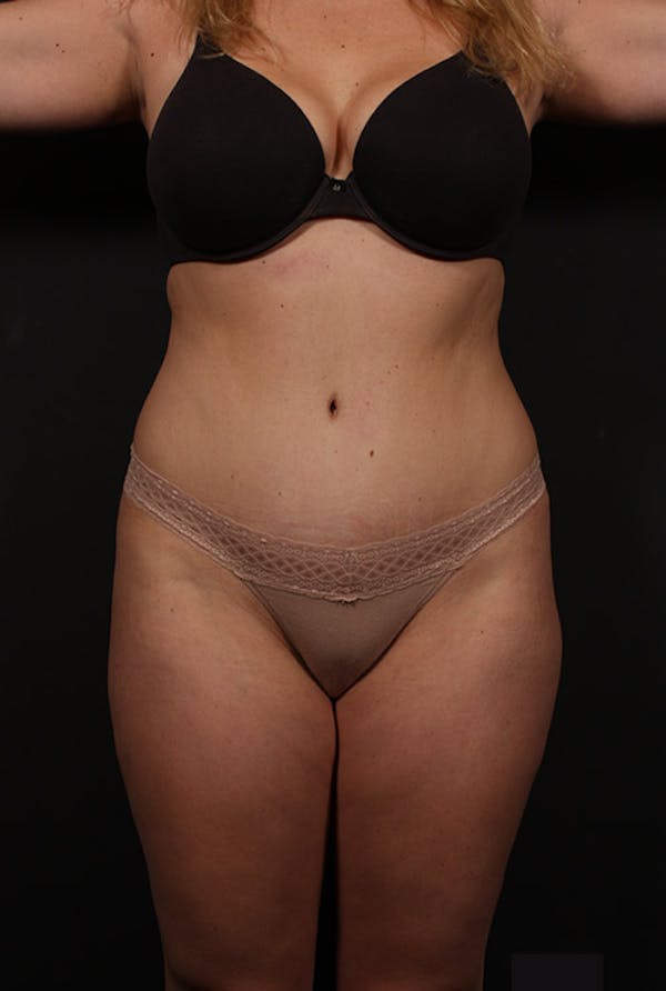 Liposuction Before & After Gallery - Patient 14089847 - Image 3