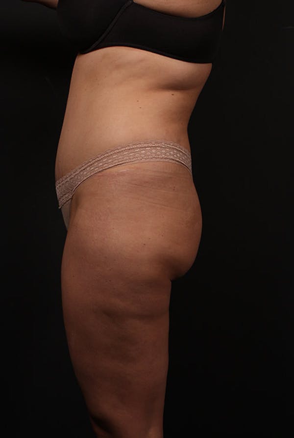 Liposuction Before & After Gallery - Patient 14089847 - Image 5