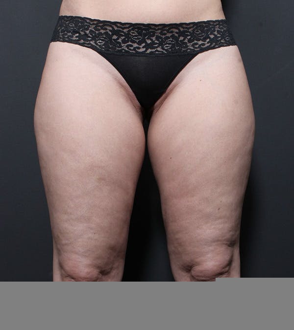 Liposuction Before & After Gallery - Patient 14089849 - Image 1
