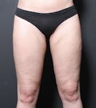 Liposuction Before & After Gallery - Patient 14089849 - Image 2