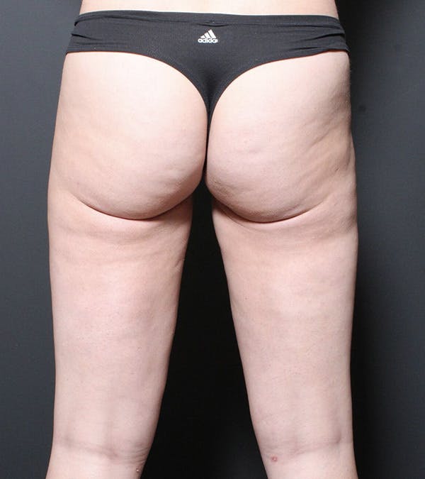 Liposuction Before & After Gallery - Patient 14089849 - Image 4