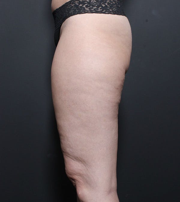 Liposuction Before & After Gallery - Patient 14089849 - Image 5