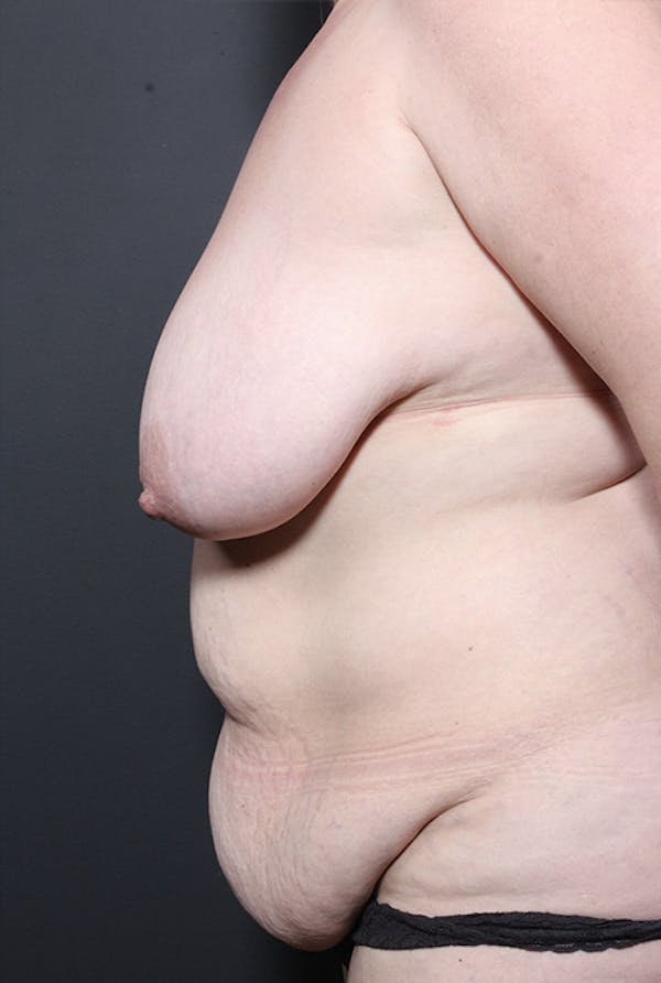 Liposuction Before & After Gallery - Patient 14089851 - Image 5
