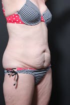 Liposuction Before & After Gallery - Patient 14089872 - Image 1