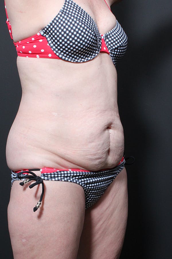 Liposuction Before & After Gallery - Patient 14089872 - Image 1