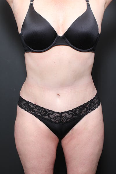 Liposuction Before & After Gallery - Patient 14089872 - Image 4