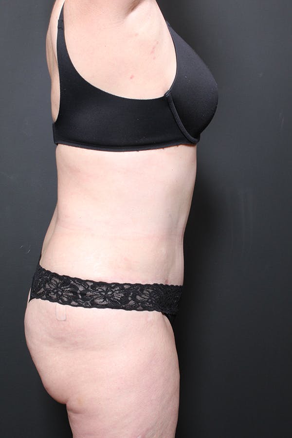 Liposuction Before & After Gallery - Patient 14089872 - Image 6