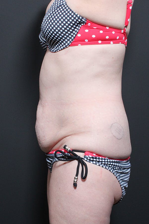 Liposuction Before & After Gallery - Patient 14089872 - Image 9