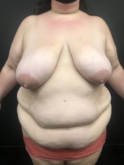 Plus Size Tummy Tuck® Before & After Gallery - Patient 17337135 - Image 1