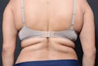 Bra Line Back Lift™ Before & After Gallery - Patient 19827720 - Image 1
