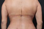 Bra Line Back Lift™ Before & After Gallery - Patient 19827720 - Image 2