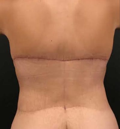 Bra Line Back Lift Before and After Pictures Case 1335