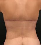 Bra Line Back Lift™ Before & After Gallery - Patient 19827721 - Image 2