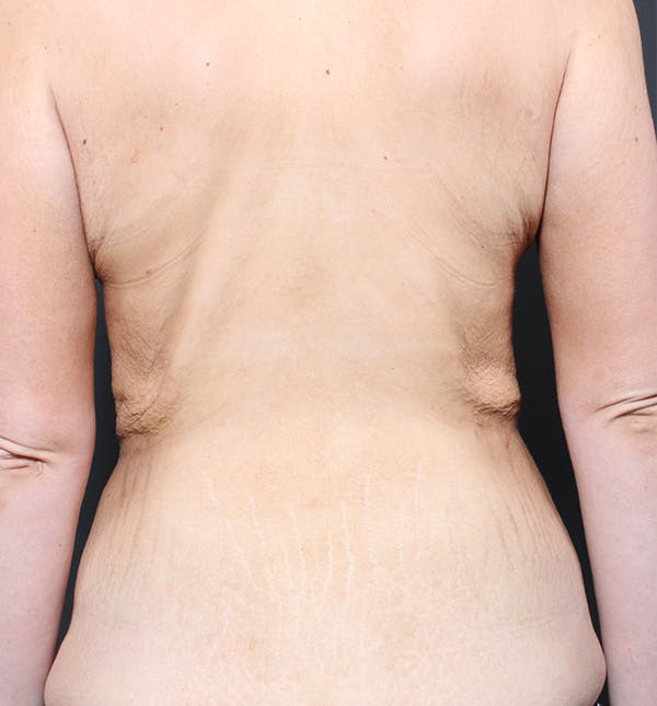 Bra Line Back Lift™ Before & After Gallery - Patient 19827723 - Image 1