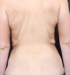 Bra Line Back Lift™ Before & After Gallery - Patient 19827723 - Image 1