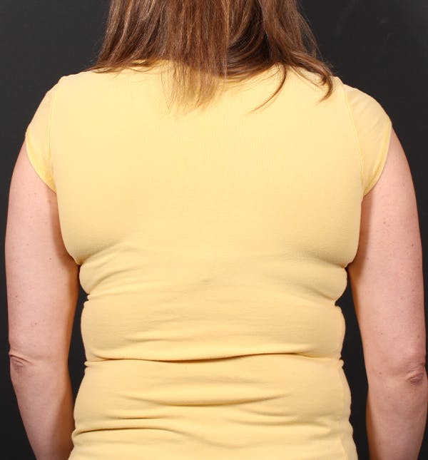 Bra Line Back Lift Before & After Photos Patient 1154