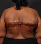 Bra Line Back Lift™ Before & After Gallery - Patient 19827725 - Image 2