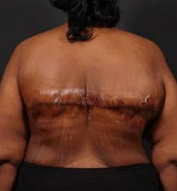 Bra Line Back Lift™ Before & After Gallery - Patient 19827725 - Image 2