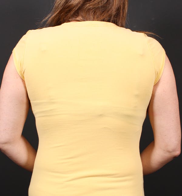 Bra Line Back Lift Before & After Photos Patient 1154