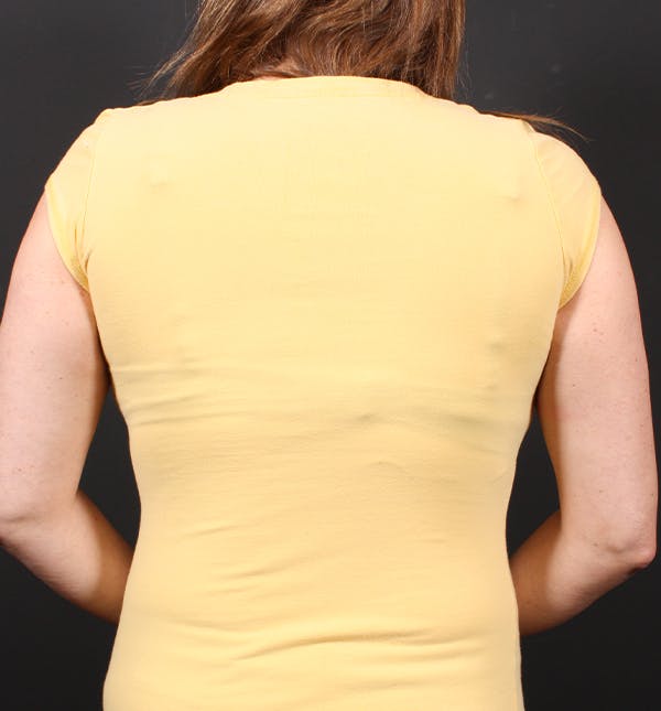 Bra Line Back Lift™ Before & After Gallery - Patient 19827724 - Image 4