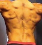 Bra Line Back Lift™ Before & After Gallery - Patient 19827727 - Image 2