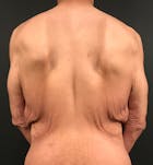 Bro Line Back Lift Before & After Gallery - Patient 19829433 - Image 1