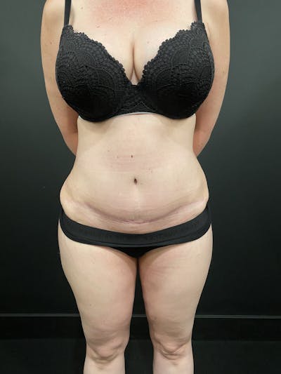 Tummy Tuck Before & After Gallery - Patient 20536490 - Image 4